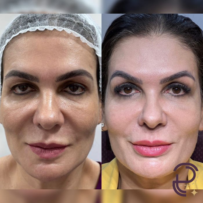 Antes e depois 28