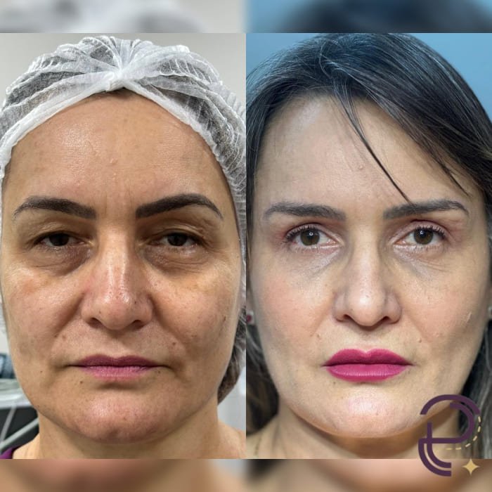 Antes e depois 32